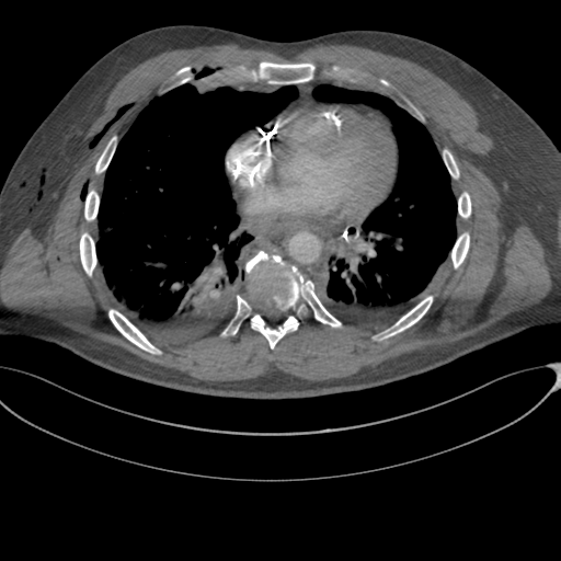 File:Chest multitrauma - aortic injury (Radiopaedia 34708-36147 A 182).png