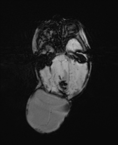 Chiari III malformation with occipital encephalocele (Radiopaedia 79446-92559 Axial SWI 28).jpg