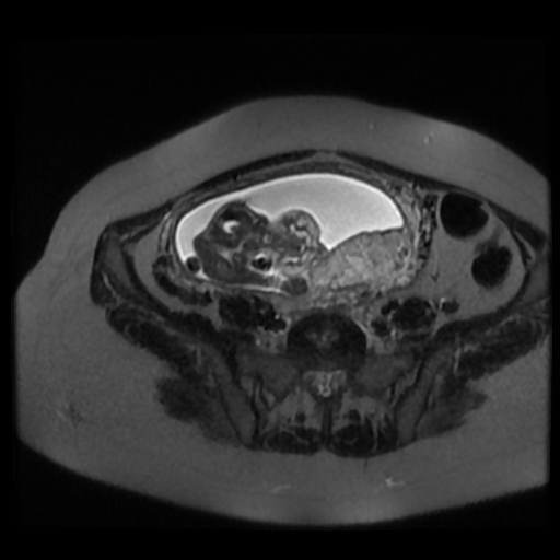Chiari II malformation - fetal MRI (Radiopaedia 68099-77581 Axial T2-SSFSE 34).jpg