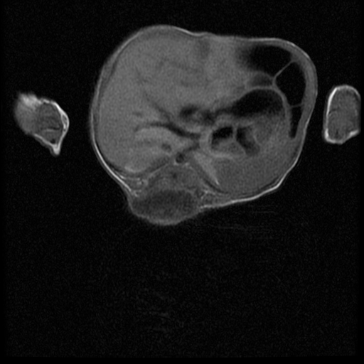 File:Chiari II malformation with spinal meningomyelocele (Radiopaedia 23550-23652 Axial T1 9).jpg