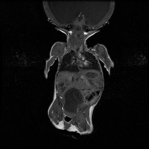 File:Chiari II malformation with spinal meningomyelocele (Radiopaedia 23550-23652 Coronal T1 1).jpg