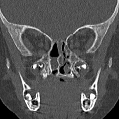 Choanal atresia (Radiopaedia 88525-105975 Coronal bone window 61).jpg
