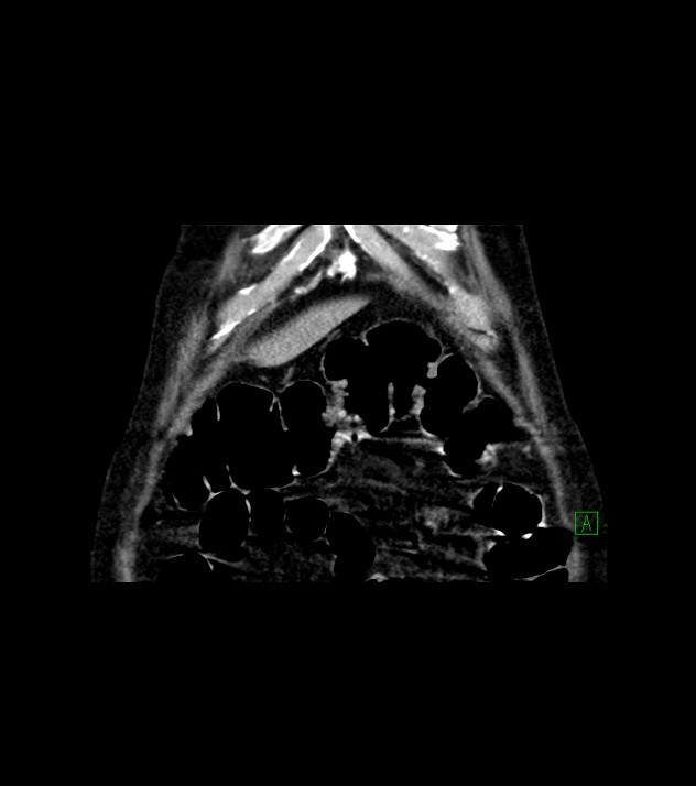 Cholangiocarcinoma with cerebral metastases (Radiopaedia 83519-98629 Coronal C+ delayed 10).jpg