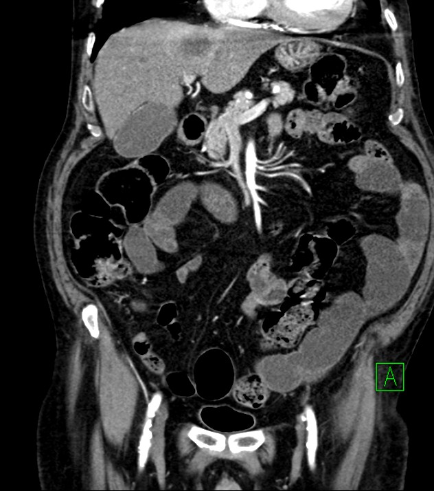 Cholangiocarcinoma with cerebral metastases (Radiopaedia 83519-98629 E 37).jpg