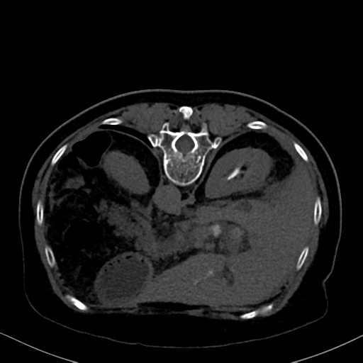 File:Cholecystitis - obstructive choledocholitiasis (CT intravenous cholangiography) (Radiopaedia 43966-47479 Axial 7).png