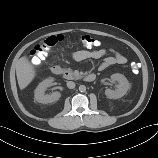 File:Cholecystitis with focal perforation and hepatic abscess (Radiopaedia 37189-38945 Axial non-contrast 36).png