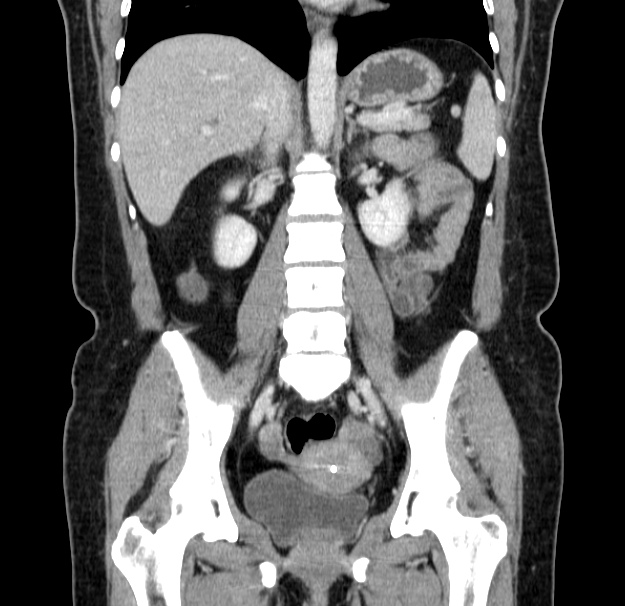 Choledocholithiasis on CT and MRI (Radiopaedia 24825-25087 C 30).jpg
