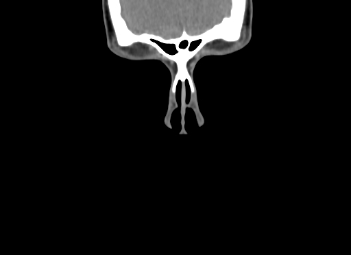 Chondroblastic osteosarcoma (Radiopaedia 67363-76741 D 3).jpg
