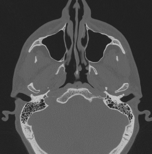 File:Chondrosarcoma (clivus) (Radiopaedia 46895-51425 Axial bone window 59).png