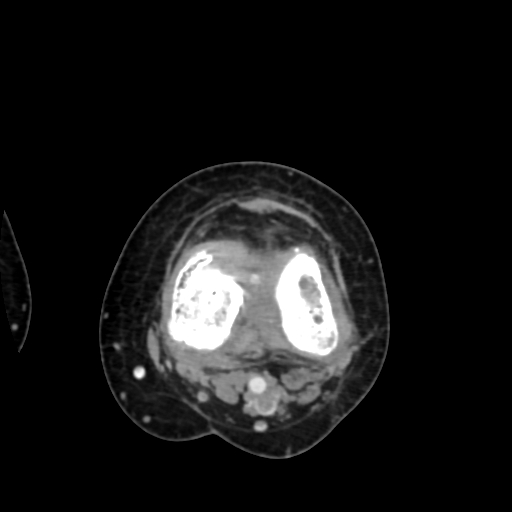 File:Chondrosarcoma - femur (Radiopaedia 64187-72954 Axial with contrast 54).jpg