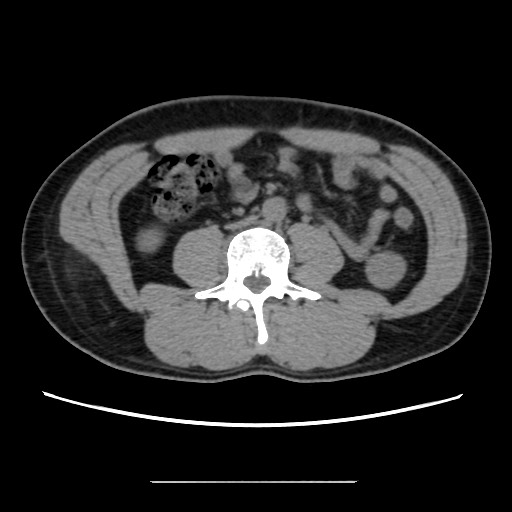 Chondrosarcoma of iliac wing (Radiopaedia 63861-72599 Axial non-contrast 7).jpg