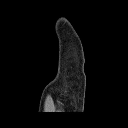 Chondrosarcoma of iliac wing (Radiopaedia 63861-72599 F 10).jpg