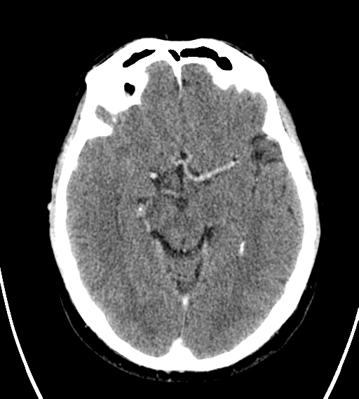 File:Chondrosarcoma of skull base- grade II (Radiopaedia 40948-43653 Axial Contrast 13).png