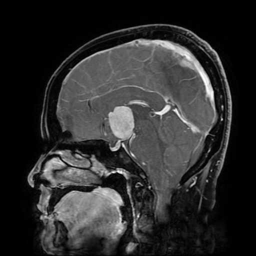 File:Chordoid glioma of third ventricle (Radiopaedia 91612-109340 F 108).jpg