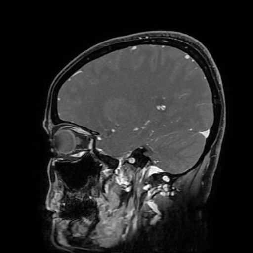 File:Chordoid glioma of third ventricle (Radiopaedia 91612-109340 F 76).jpg