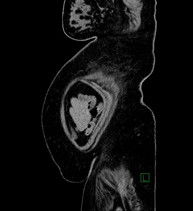 Chromophobe renal cell carcinoma (Radiopaedia 84239-99519 G 10).jpg