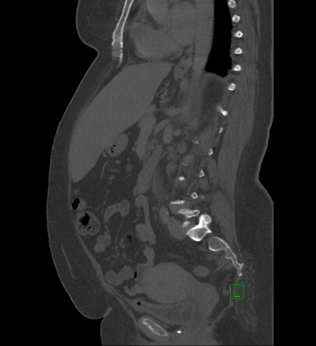 Chromophobe renal cell carcinoma (Radiopaedia 84239-99519 Sagittal bone window 50).jpg