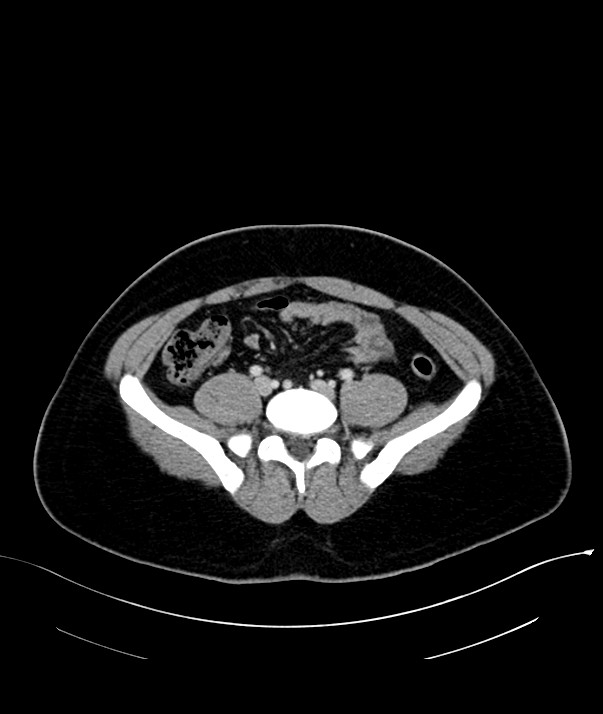 Chromophobe renal cell carcinoma (Radiopaedia 84255-99542 F 58).jpg