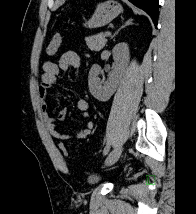 Chromophobe renal cell carcinoma (Radiopaedia 84286-99573 C 59).jpg
