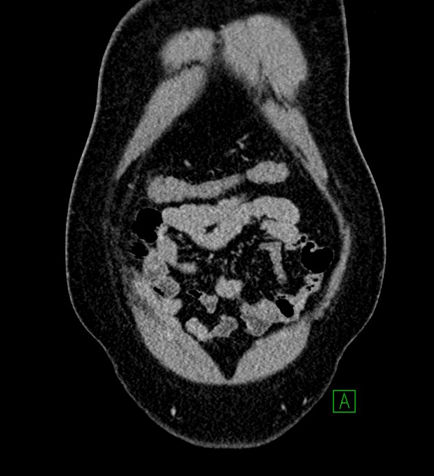 Chromophobe renal cell carcinoma (Radiopaedia 84286-99573 H 24).jpg