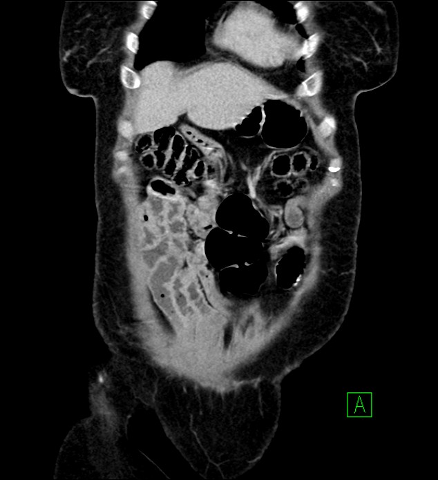 Chromophobe renal cell carcinoma (Radiopaedia 84290-99582 F 10).jpg