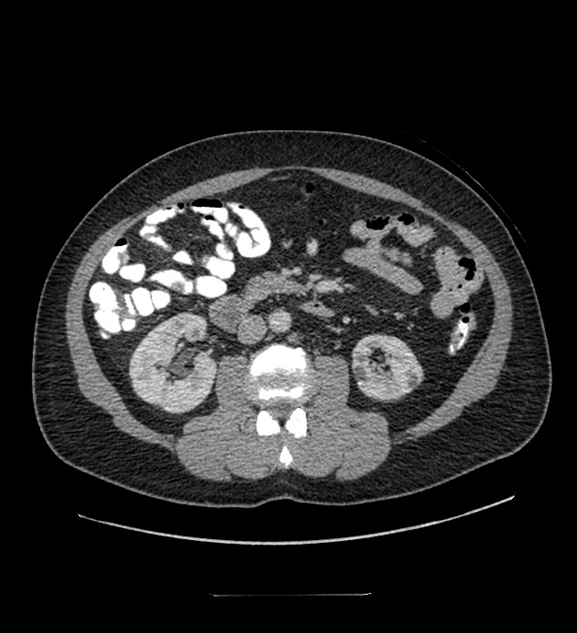 Chromophobe renal cell carcinoma (Radiopaedia 84337-99644 C 62).jpg