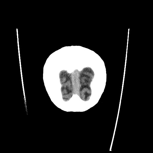 File:Chronic bilateral subdural hygroma (Radiopaedia 85801-101622 Coronal non-contrast 73).jpg