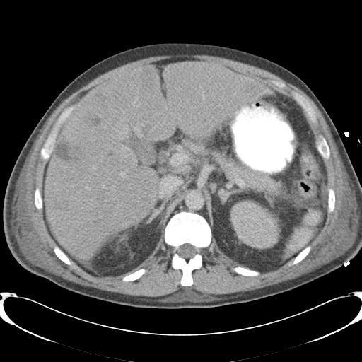 Chronic diverticulitis complicated by hepatic abscess and portal vein thrombosis (Radiopaedia 30301-30938 A 31).jpg