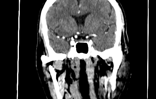 Chronic invasive fungal sinusitis (Radiopaedia 91563-109286 D 112).jpg