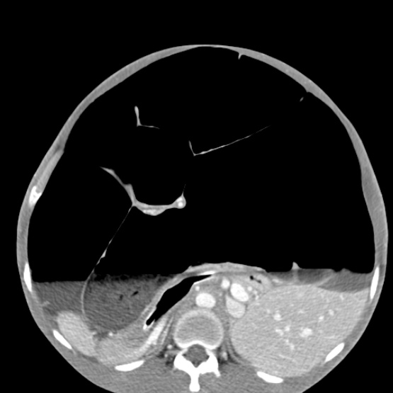 Chronic large bowel pseudo-obstruction (Radiopaedia 43181-46492 A 73).jpg