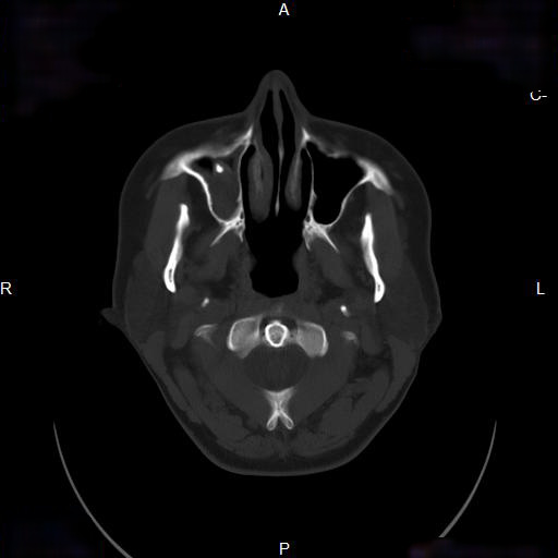File:Chronic maxillary sinusitis with a foreign body (dental filling material) (Radiopaedia 7811-8639 Axial bone window 4).jpg