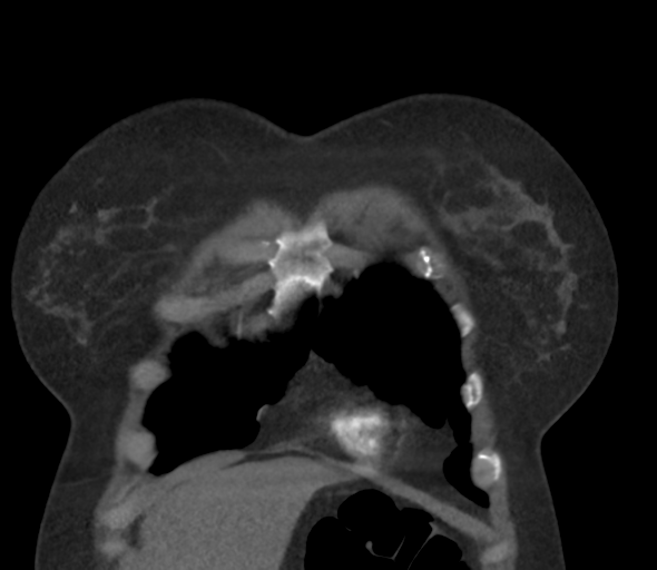 File:Chronic pulmonary embolus (Radiopaedia 39129-41341 Coronal C+ CTPA 15).png