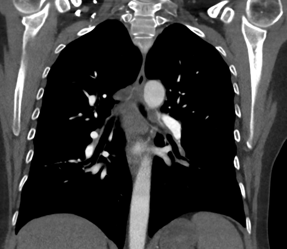 File:Chronic pulmonary embolus (Radiopaedia 39129-41341 Coronal C+ CTPA 52).png