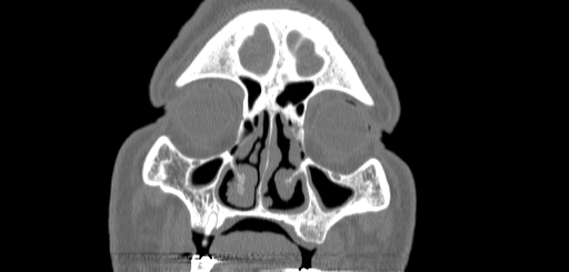 Chronic sphenoidal sinusitis (Radiopaedia 62030-70122 Coronal bone window 30).jpg