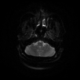 Chronic submandibular sialadenitis (Radiopaedia 61852-69885 Axial DWI 35).jpg