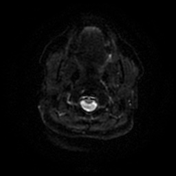 Chronic submandibular sialadenitis (Radiopaedia 61852-69885 Axial DWI 39).jpg