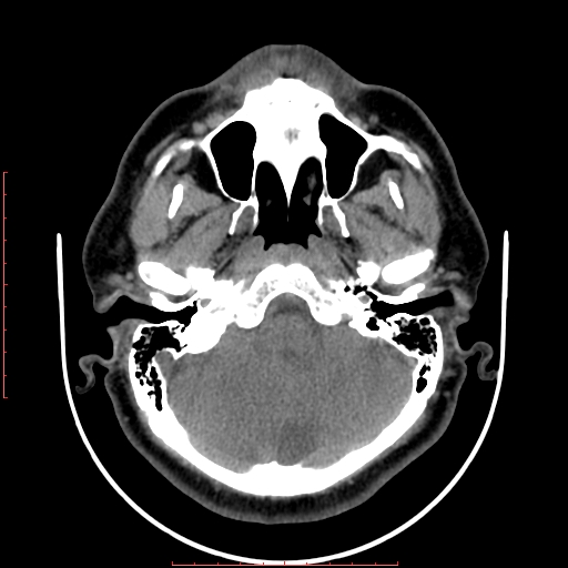 Chronic submandibular sialolithiasis (Radiopaedia 69817-79814 Axial non-contrast 14).jpg