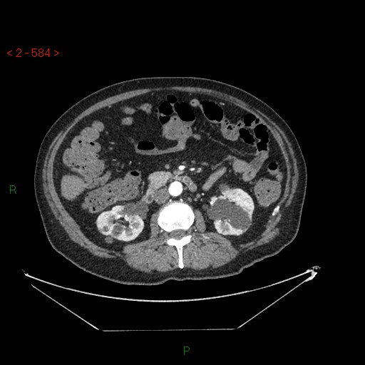 Circumaortic left renal vein and doubled left renal arteries (Radiopaedia 52268-58158 A 120).jpg