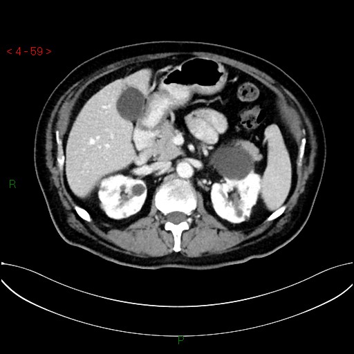 File:Circumaortic left renal vein and doubled left renal arteries (Radiopaedia 52268-58158 B 19).jpg