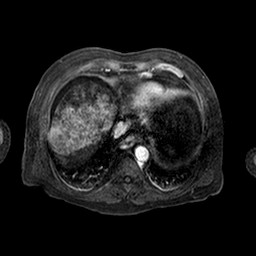 Cirrhosis and hepatocellular carcinoma in the setting of hemochromatosis (Radiopaedia 75394-86594 Axial T1 C+ fat sat 156).jpg