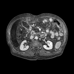 Cirrhosis and hepatocellular carcinoma in the setting of hemochromatosis (Radiopaedia 75394-86594 Axial T1 C+ fat sat 281).jpg
