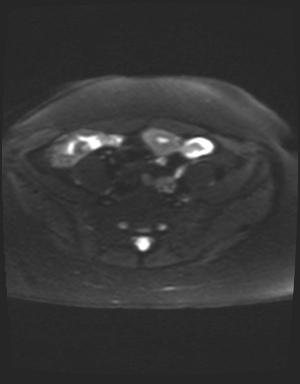 File:Class II Mullerian duct anomaly- unicornuate uterus with rudimentary horn and non-communicating cavity (Radiopaedia 39441-41755 Axial DWI 5).jpg