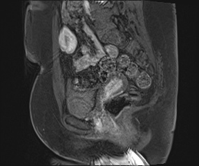 Class II Mullerian duct anomaly- unicornuate uterus with rudimentary horn and non-communicating cavity (Radiopaedia 39441-41755 G 47).jpg