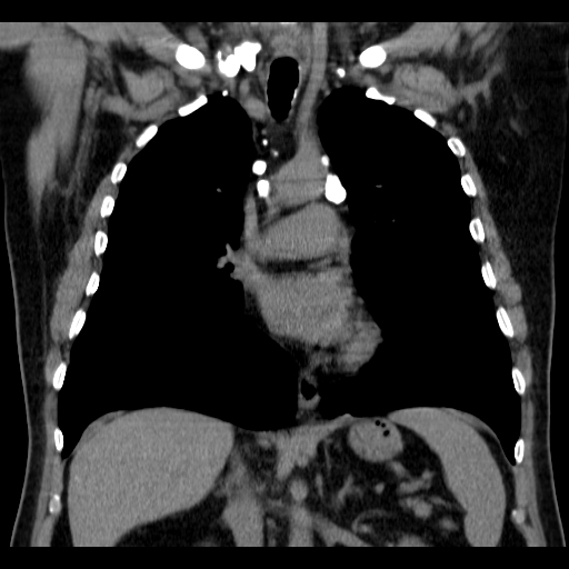 File:Classic complicated silicosis (Radiopaedia 49720-54961 Coronal liver window 29).jpg