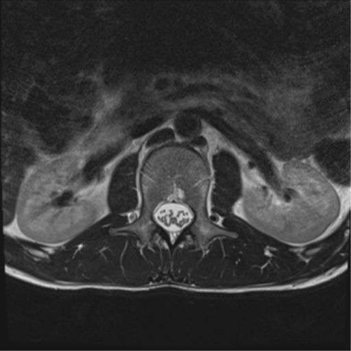 File:Clear cell meningoma - lumbar spine (Radiopaedia 60116-67690 Axial T2 37).png