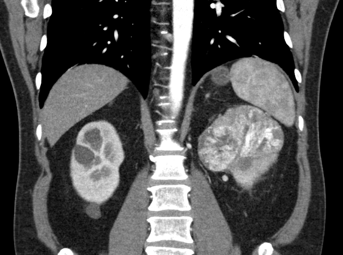 File:Clear cell renal cell carcinoma (Radiopaedia 61449-69393 C 30).jpg