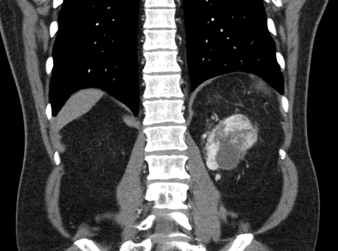 File:Clear cell renal cell carcinoma (Radiopaedia 61449-69393 C 39).jpg