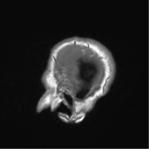 Clival chordoma invading the hypoglossal canal (Radiopaedia 48850-53887 Sagittal T1 11).png