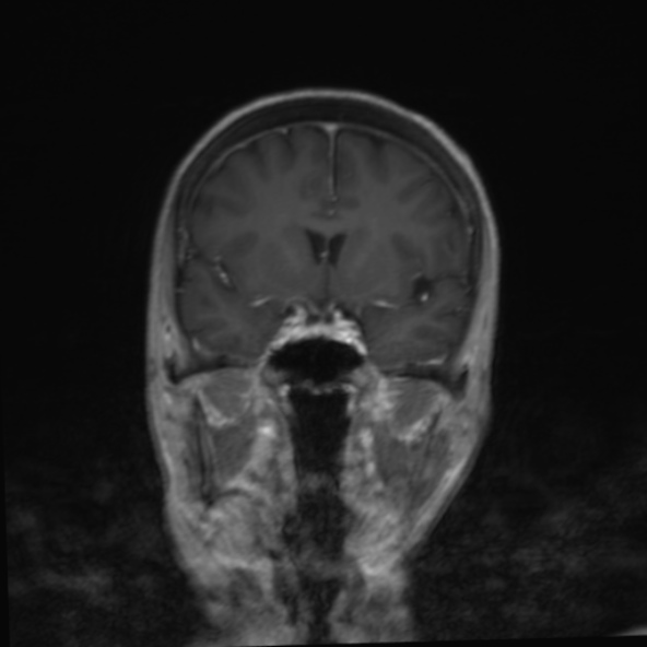 File:Clival meningioma (Radiopaedia 53278-59248 F 12).jpg