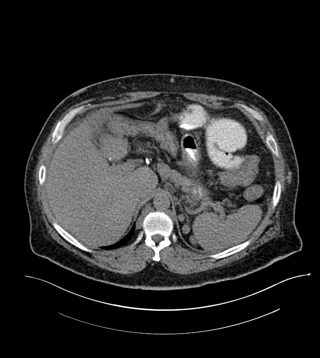 Closed-loop small bowel obstruction-internal hernia (Radiopaedia 78439-91096 Axial non-contrast 37).jpg